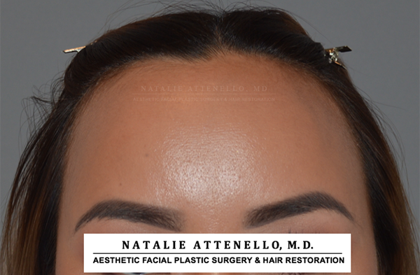 Hairline Lowering/Forehead Reduction