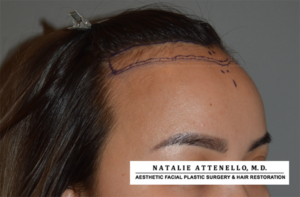 Before photo of patient before forehead reduction surgery by Beverly Hills plastic surgeon Dr. Attenello