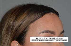 Results of patient who received forehead reduction surgery by Beverly Hills plastic surgeon Dr. Attenello