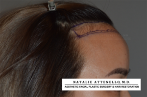 Close up view of patient with surgical marker lines on forehead before hairline lowering procedure