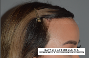 Final result of patient who received a hairline lowering procedure by Dr. Natalie Attenello