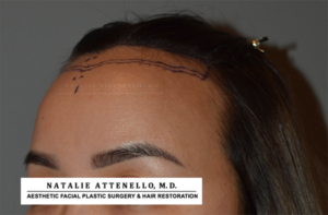 Close up view of patient with surgical marker lines on forehead before forehead reduction surgery