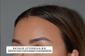 Final result of patient who underwent forehead reduction surgery by Dr. Natalie Attenello in Beverly Hills