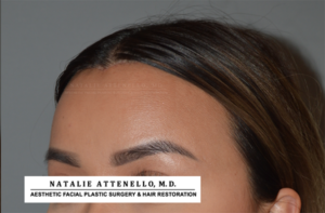 Hairline Lowering/Forehead Reduction