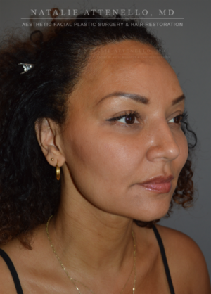 Hairline Lowering/Forehead Reduction Case 4213 Before Photo Hairline Lowering/Forehead Reduction