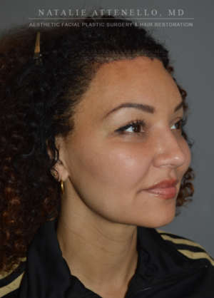 Hairline Lowering/Forehead Reduction Case 4213 After Photo Hairline Lowering/Forehead Reduction