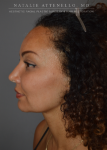 Side view of a patient before from hairline lowering procedure performed by Dr. Natalie Attenello