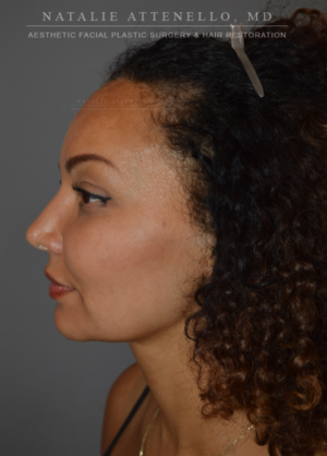 Hairline Lowering/Forehead Reduction Case 4213 Before Photo Hairline Lowering/Forehead Reduction