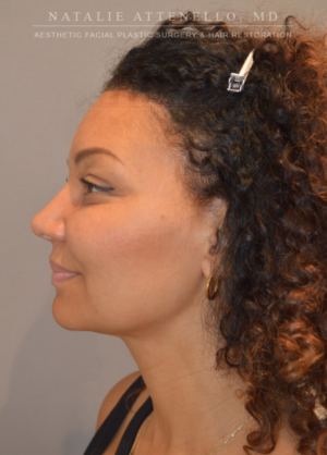 Hairline Lowering/Forehead Reduction Case 4213 After Photo Hairline Lowering/Forehead Reduction