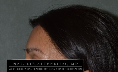 Hairline Lowering/Forehead Reduction