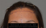 Hairline Lowering/Forehead Reduction