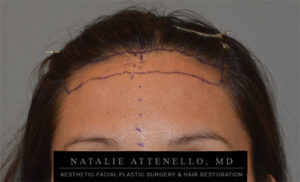 Photo of patient before forehead reduction surgery with surgical marker lines on her forehead