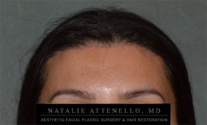 After photo of patient following hairline lowering procedure by Dr. Natalie Attenello in Beverly Hills