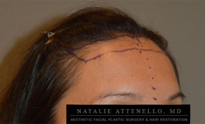 Photo of patient before a hairline lowering procedure with surgical marker lines on her forehead