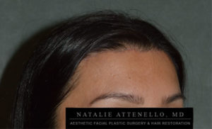 Results of patient who received forehead reduction surgery by Dr. Natalie Attenello in Beverly Hills
