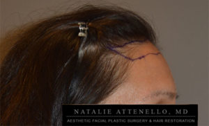 Close up side view of patient's forehead before hairline lowering procedure by Dr. Natalie Attenello