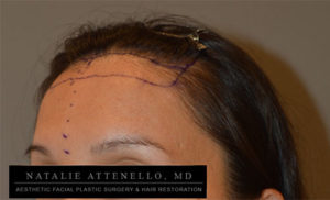 Close up view of patient's forehead before forehead reduction surgery by Dr. Natalie Attenello
