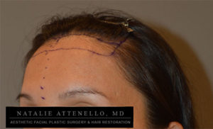 Hairline Lowering/Forehead Reduction