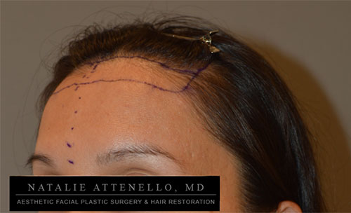 Hairline Lowering/Forehead Reduction