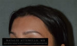 Hairline Lowering/Forehead Reduction