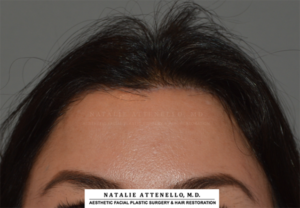 Close of view of patient after corrective forehead reduction procedure by Dr. Attenello in Beverly Hills