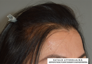 View of patient's forehead before corrective hairline lowering by Beverly Hills surgeon Dr. Attenello