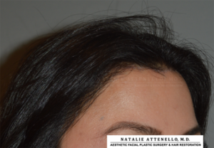 View of patient's forehead after corrective hairline lowering procedure by Beverly Hills surgeon Dr. Attenello