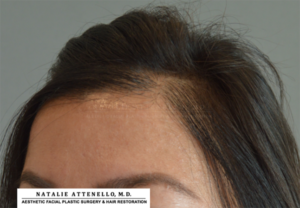 Before photo of patient undergoing corrective forehead reduction surgery by Dr. Attenello in Beverly Hills