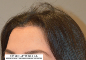 Final results of patient after corrective forehead reduction surgery by Dr. Attenello in Beverly Hills