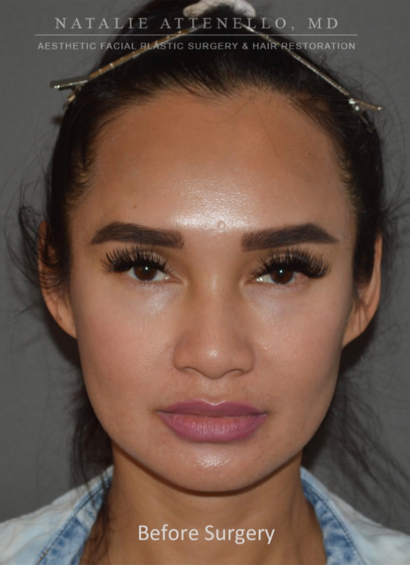 Hairline Lowering/Forehead Reduction
