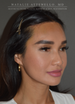 Hairline Lowering/Forehead Reduction