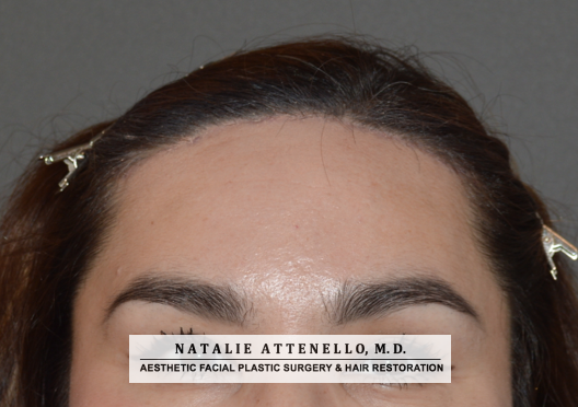 Hairline Lowering/Forehead Reduction