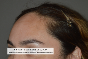 Photo of patient before forehead reduction surgery by Dr. Natalie Attenello in Beverly Hills CA
