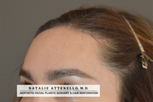 Photo of patient after forehead reduction surgery by Dr. Natalie Attenello in Beverly Hills CA