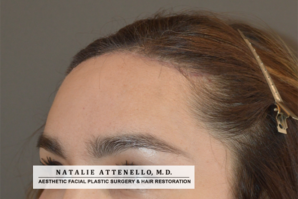 Hairline Lowering/Forehead Reduction