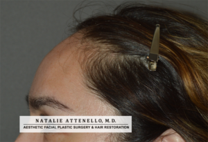 Side view of patient before hairline lowering/forehead reduction surgery by Dr. Attenello in Beverly Hills