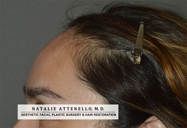 Hairline Lowering/Forehead Reduction