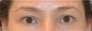Blepharoplasty Case 4385 Before Photo Blepharoplasty