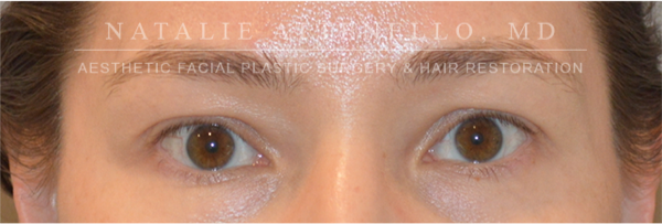 Blepharoplasty