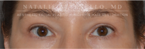 Blepharoplasty Case 4385 After Photo Blepharoplasty