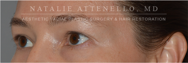 Blepharoplasty