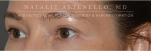 Blepharoplasty Case 4385 After Photo Blepharoplasty