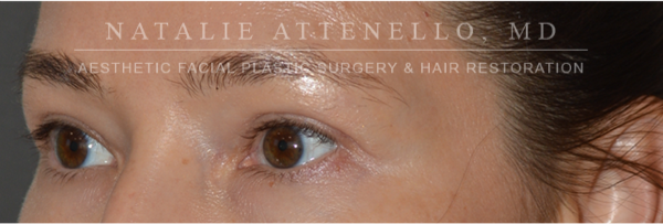 Blepharoplasty