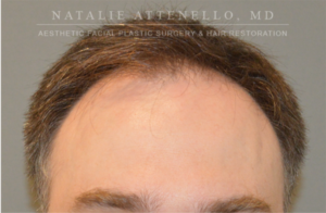 Hair Restoration Case 4386 Before Photo Hair Restoration