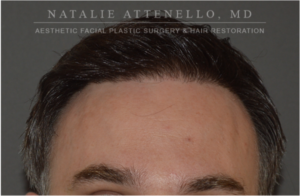Hair Restoration Case 4386 After Photo Hair Restoration