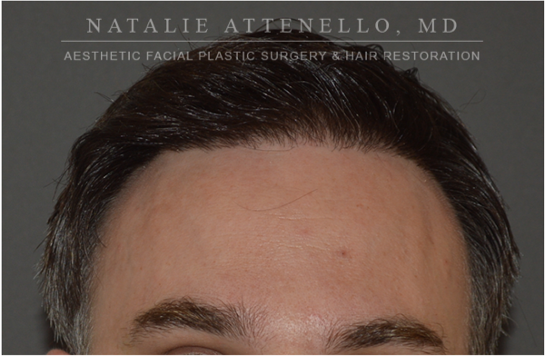 Hair Restoration