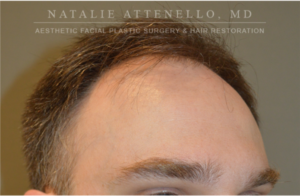 Hair Restoration Case 4386 Before Photo Hair Restoration