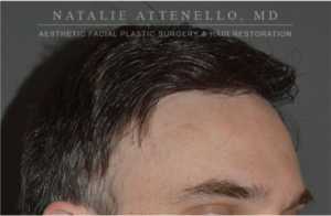 Hair Restoration Case 4386 After Photo Hair Restoration