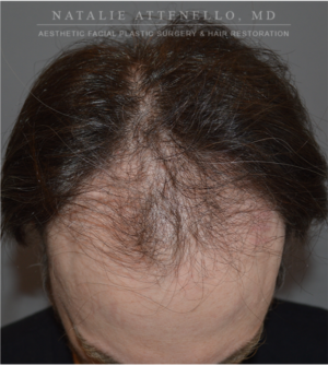 Hair Restoration Case 4386 Before Photo Hair Restoration