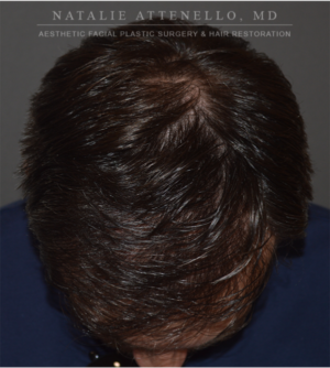 Hair Restoration Case 4386 After Photo Hair Restoration